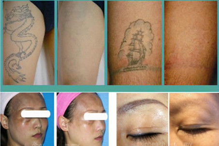 taille blanche et grise 2, solvant à commutation de Q de tache laser de tatouage de rayonnement laser de ND YAG de 8mm
